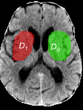 Exemplo de TC com demarcação